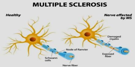 What is MS? Common Causes of MS Disease