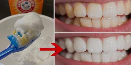 How to whiten teeth at home fast