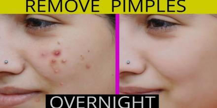 How to remove pimples