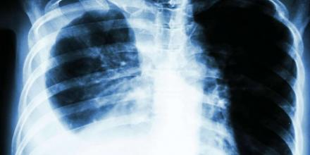 Expanded lung cancer screening. New ACS guidelines